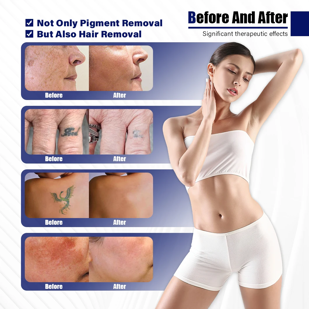 laser picosecond profesional pico second q switch nd yag laser machine nd yag for eyebrow tattoo removal