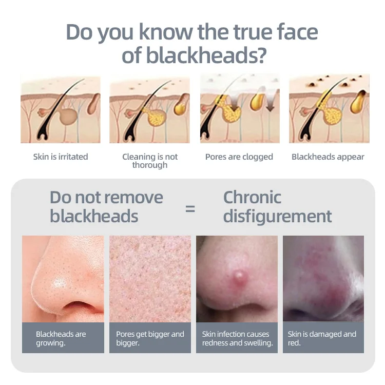 China manufacturer blackhead skin cleansing machine custom ultrasonic face scrubber black