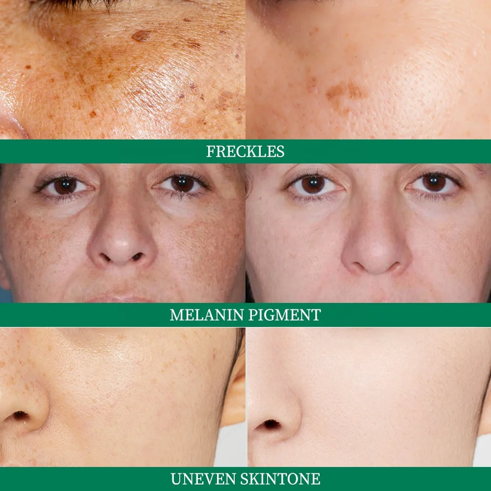 Dark Spot Remover Cream Vitamin C Lightens Skin Inhibits Melanin Pigmentation Whitening Blemish Cream Freckles Removal Cream