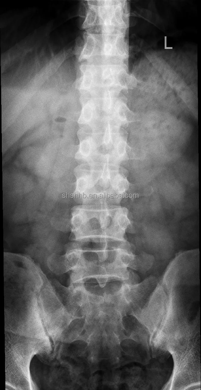 17*17 DR wired flat panel detector Medical multifunction Digital Radiography X-ray flat panel detector