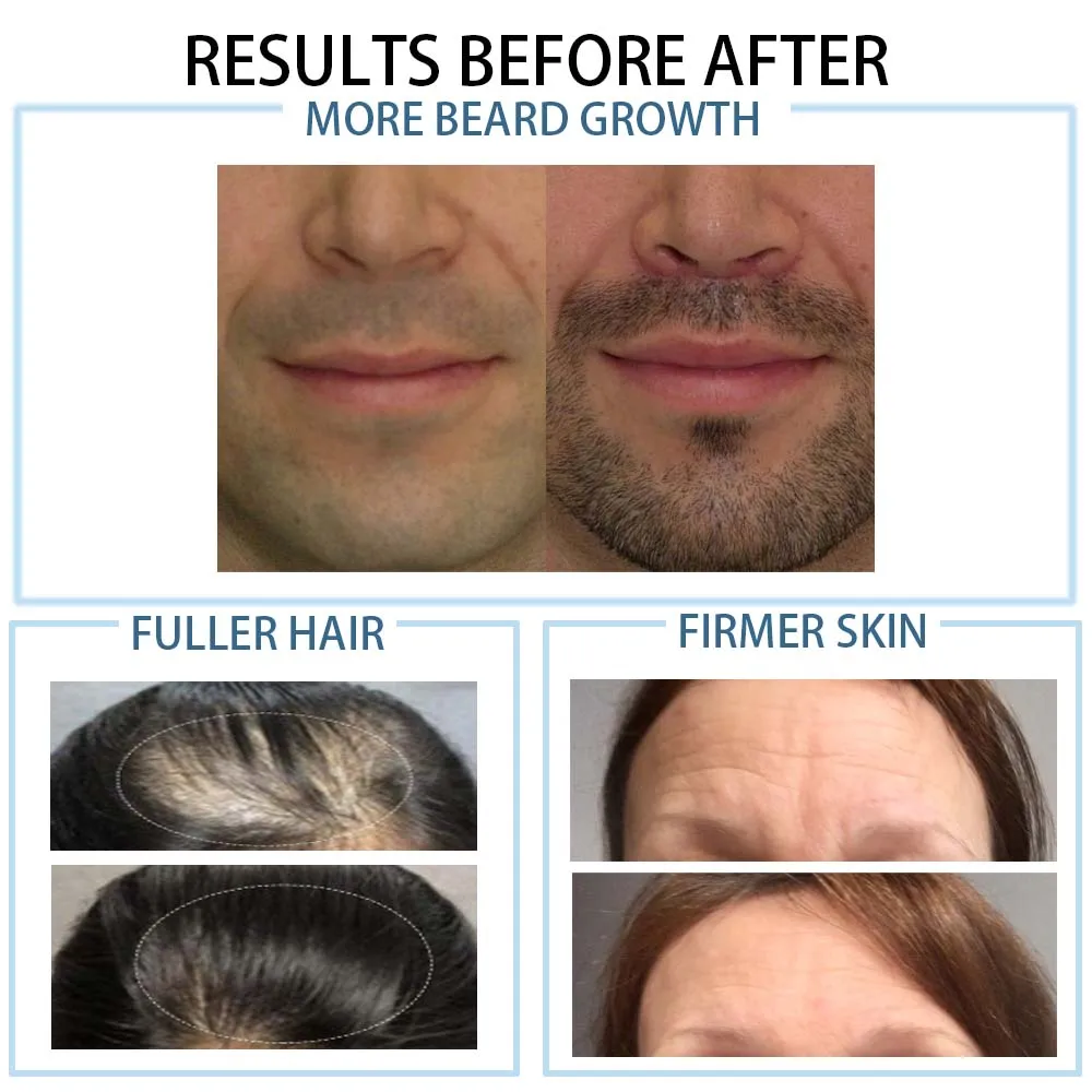 Professional Medical Grade  Microneedling Stainless Steel Titanium  Individual Real Needles 192  Skin Roller for Hair Beard Skin