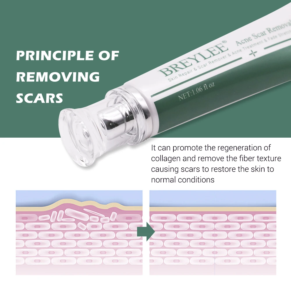 Removal Scar Cream Face Pimples Scar Stretch Marks Removal Acne Treatment Whitening Moisturizing Cream Skin Care