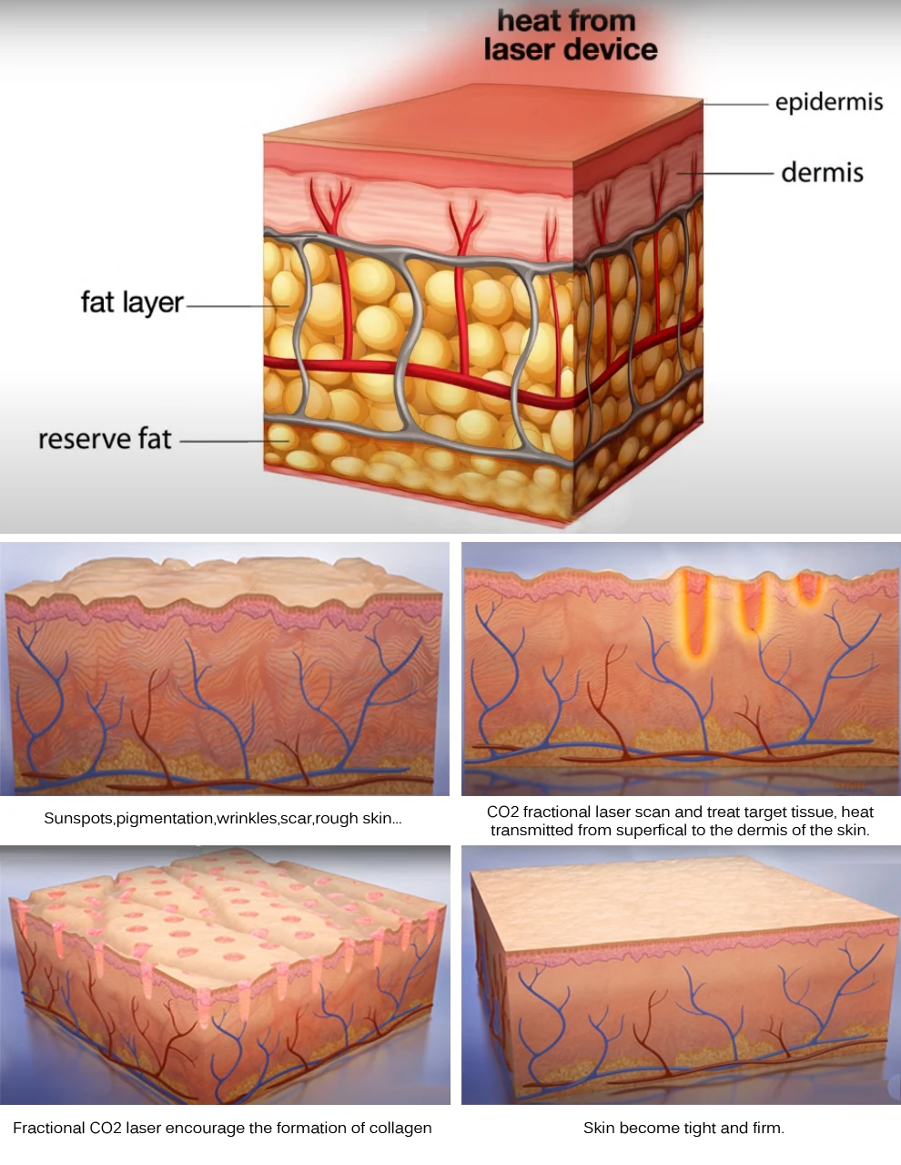 tightening skin care beauty Anti-Puffiness co2 fractional laser scar removal skin care beauty laser fractional CO2 laser