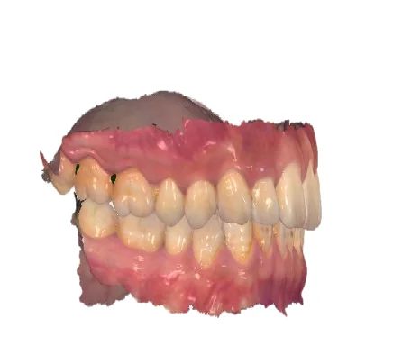 Dental Oral Therapy Equipment Dental Imaging Equipment Dental 3D Intraoral Scanner