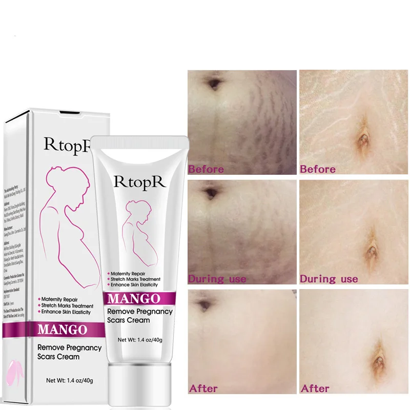 Body skin repair stretch marks removal mango remove pregnancy scars cream
