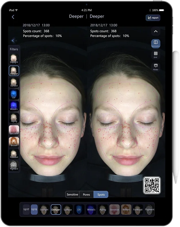 DJM Moreme Facial Skin Analysis Machine Instrument Good Comparison Before And After Treatment In Spa & Clinic