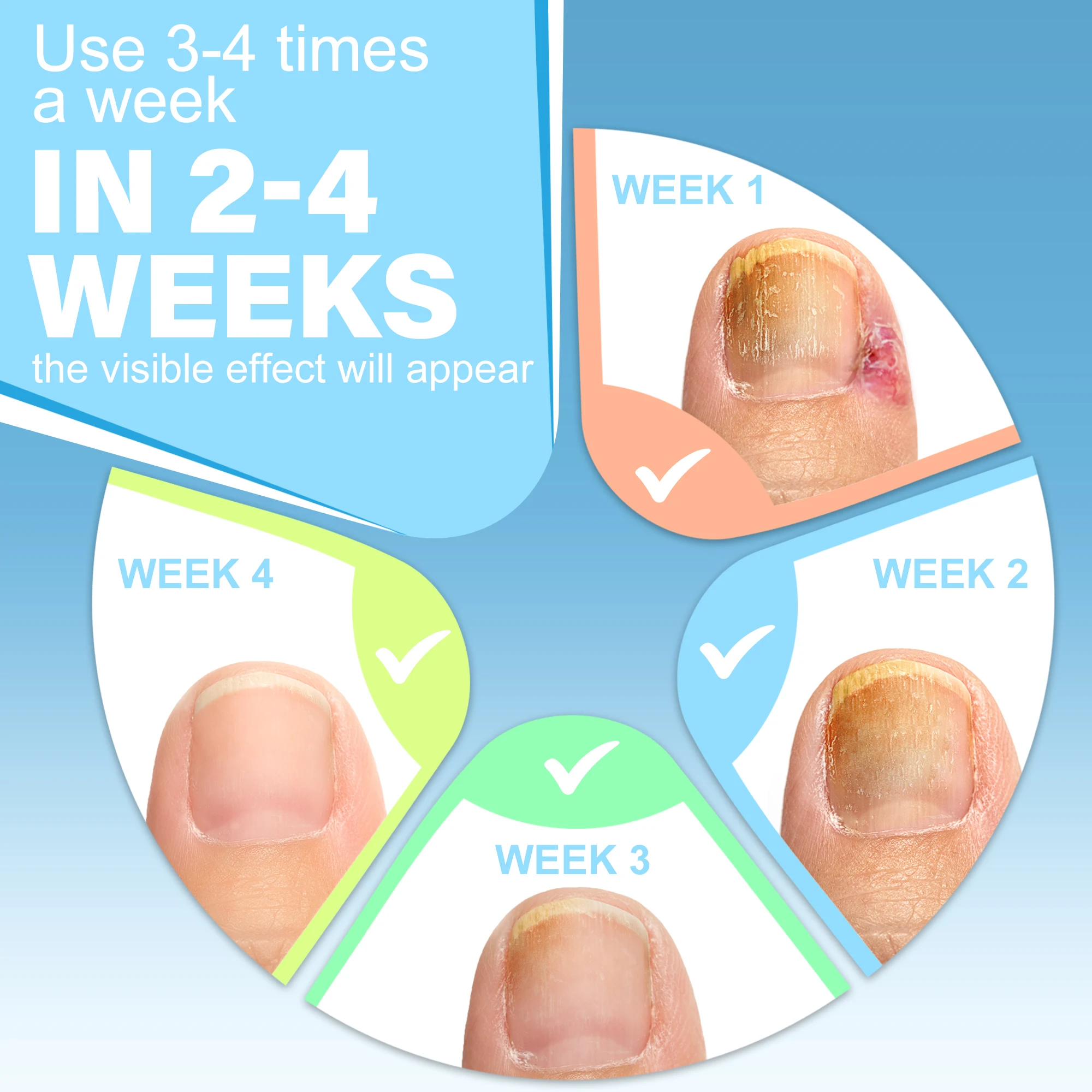 Best Nail Fungus Toenail Repair Solution Toenail Essence Oil Corrector Removal Kit Ingrown Toenail Treatment