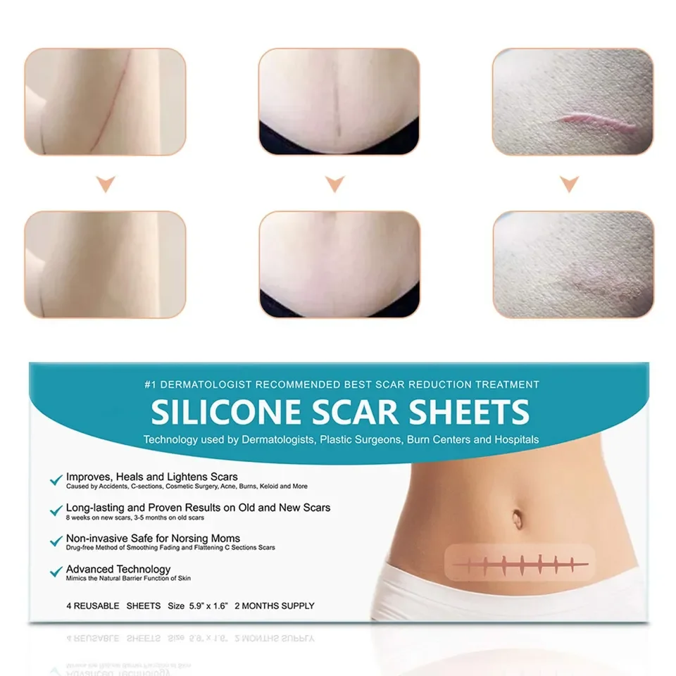 Silicone Scar Removal for Scars Caused by C-Section Surgery Burn Acne Works on Old & New Scars Reusable Sheets