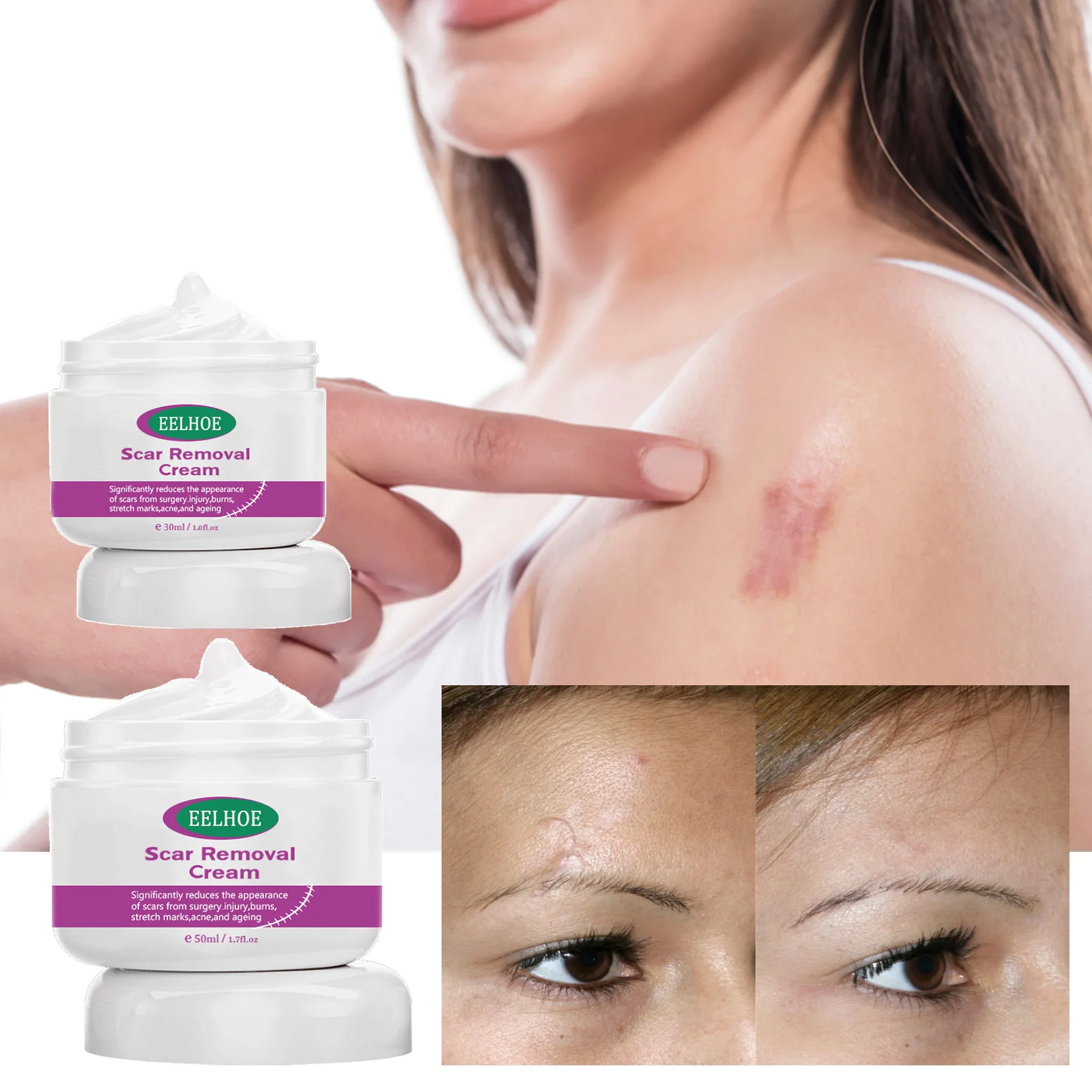 Amazon hot selling acne scar treatment ointment scar removal cream for surgical acne  scald scar
