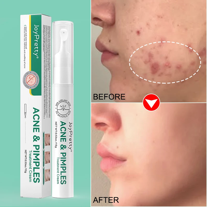 Hot selling Acne pimples cream organic Deep Removing Acne Skin Repair Whitening Face acne treatment cream
