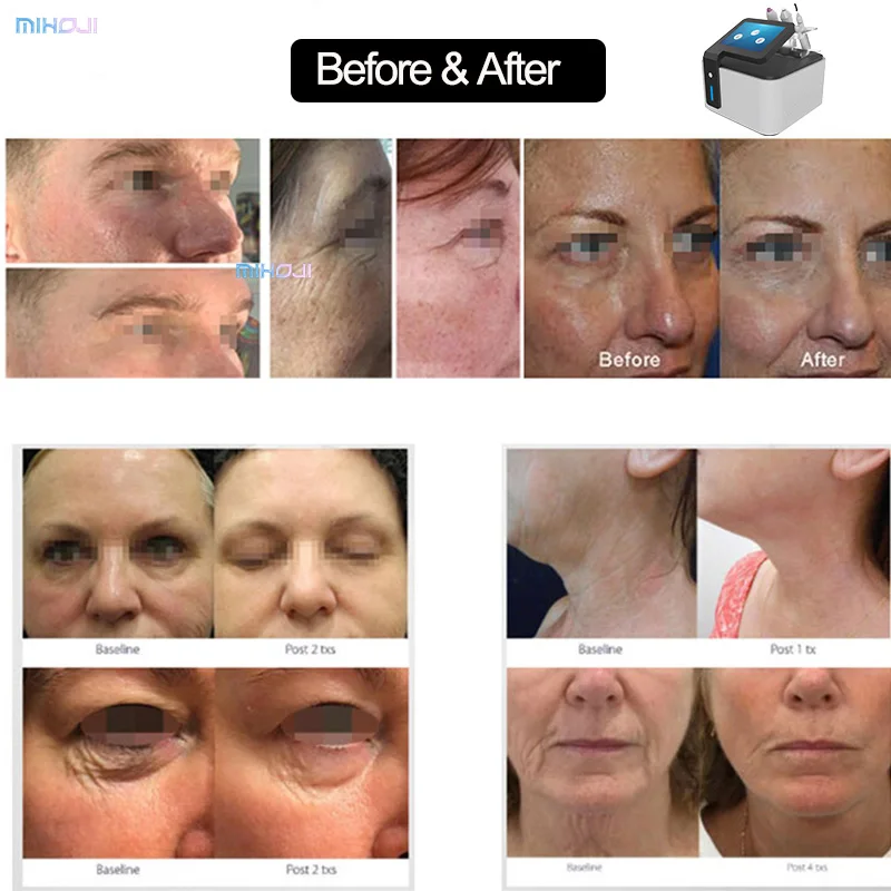 Professional scalp hair therapy plasma machine hair growth fractional plasma eyelid tightening and lifting cold plasma device