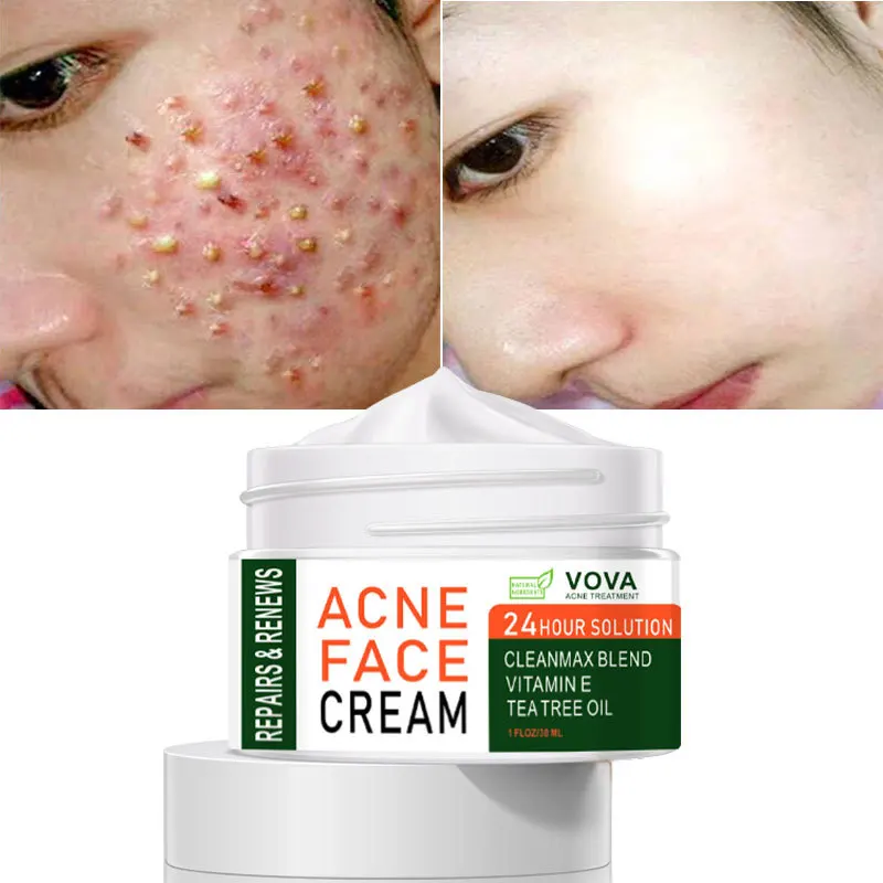 2021 Best Organic Whitening Herbal Tea Tree Oil Acne Spot Treatment Removing Anti Acne Face Cream
