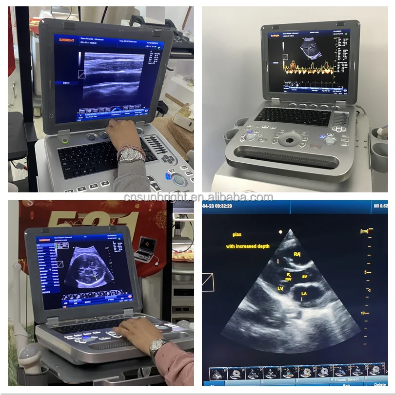 Color doppler ultrasound SUN-906B full digital ultrasound machine laptop obgyn ultrasound 3d