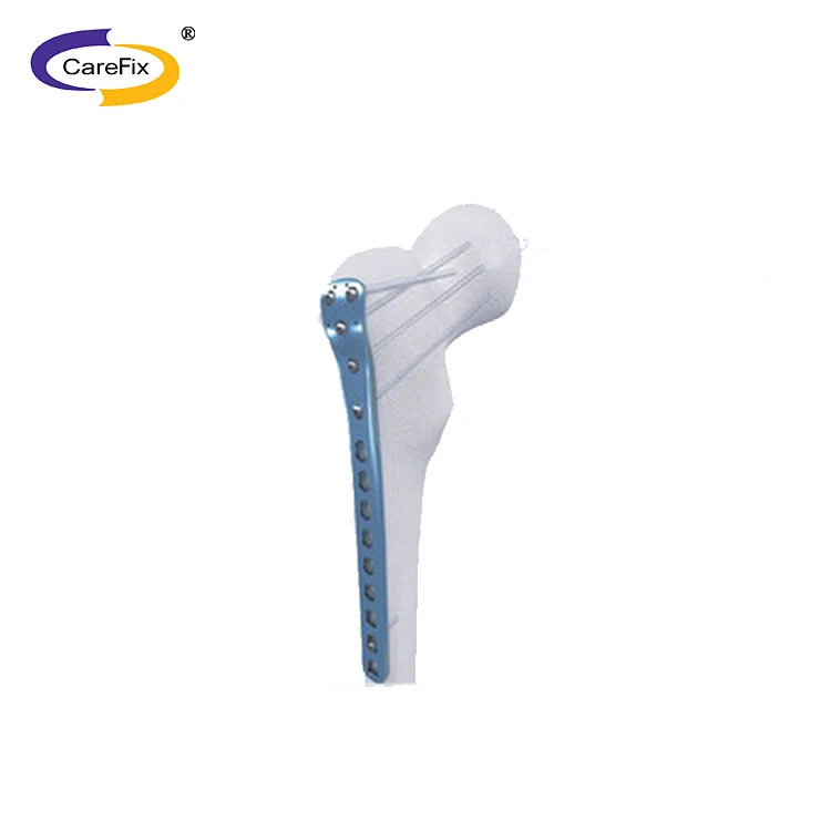 CareFix ортопедический имплантат блокировки ногтей
