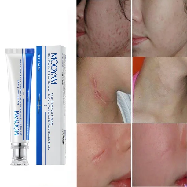 Private Label Free Sample Face Skin Stretch Marks Relief Burns Repair Cream Scar Removal Cream Scar Cream For Old Scars