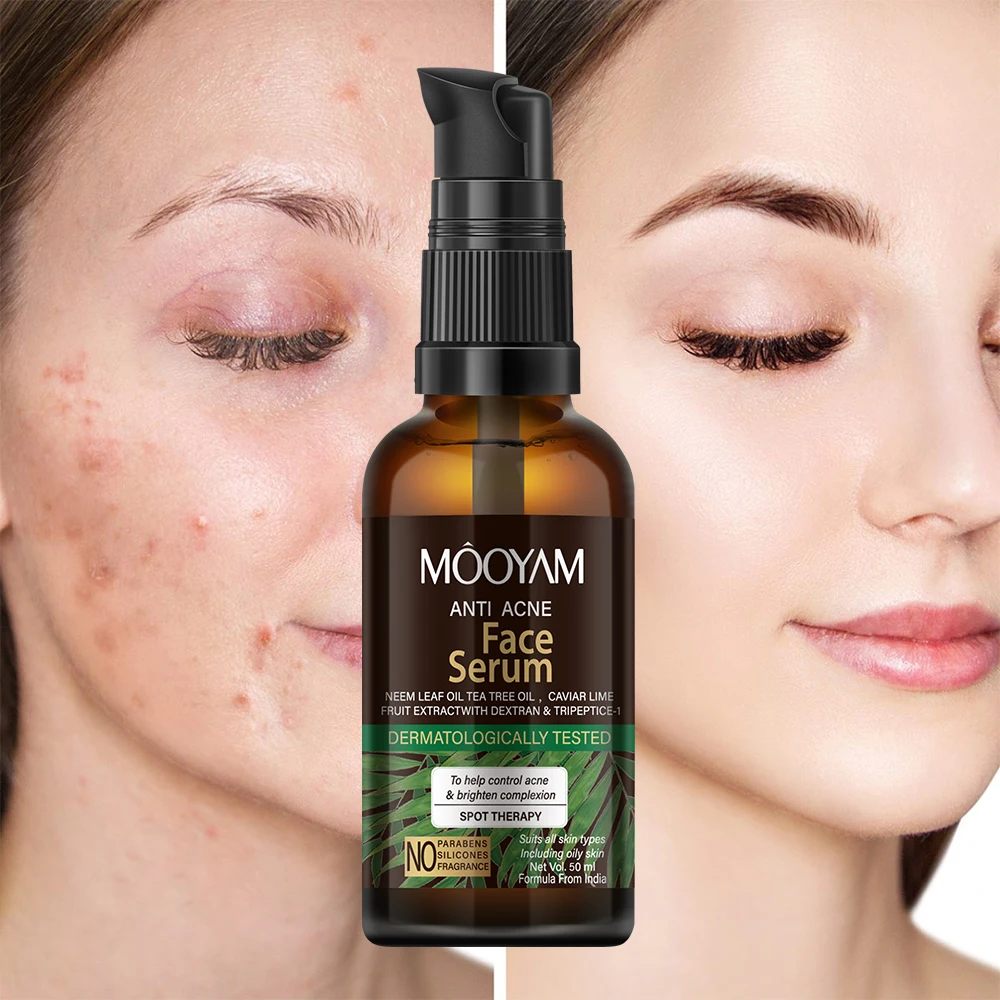 Facial Serum Lighten Old and New Acne Marks Relieve Redness Swelling and Acne Balancing oils 50ml MOOYAM Anti Acne Face Serum