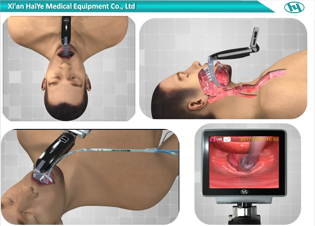 
Disposable video laryngoscope medical equipment for solve difficult intubation 