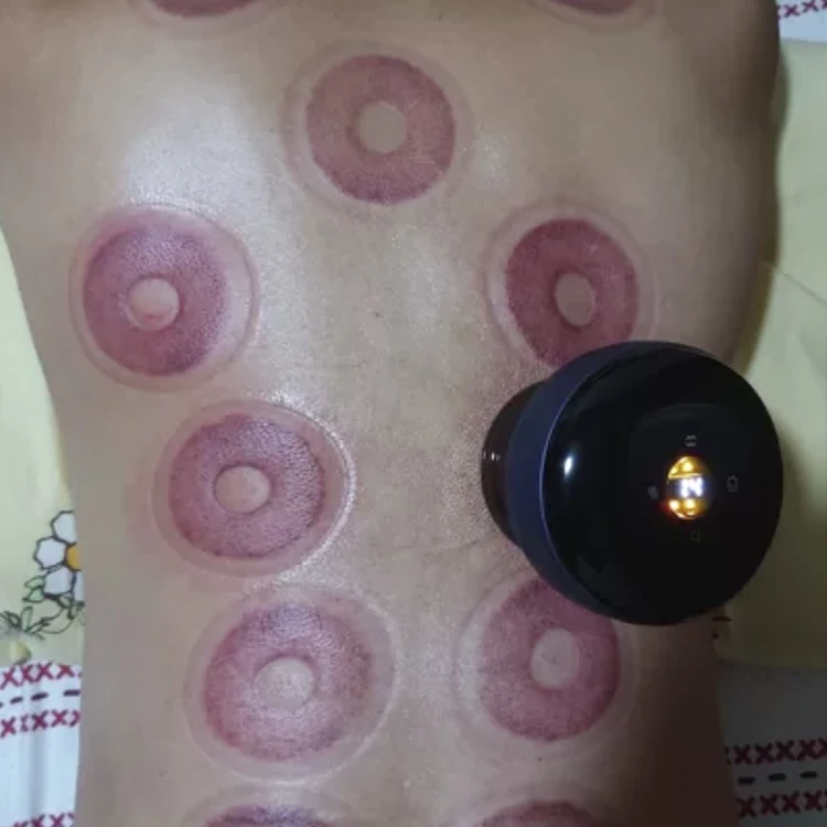 cupping therapy2.jpg