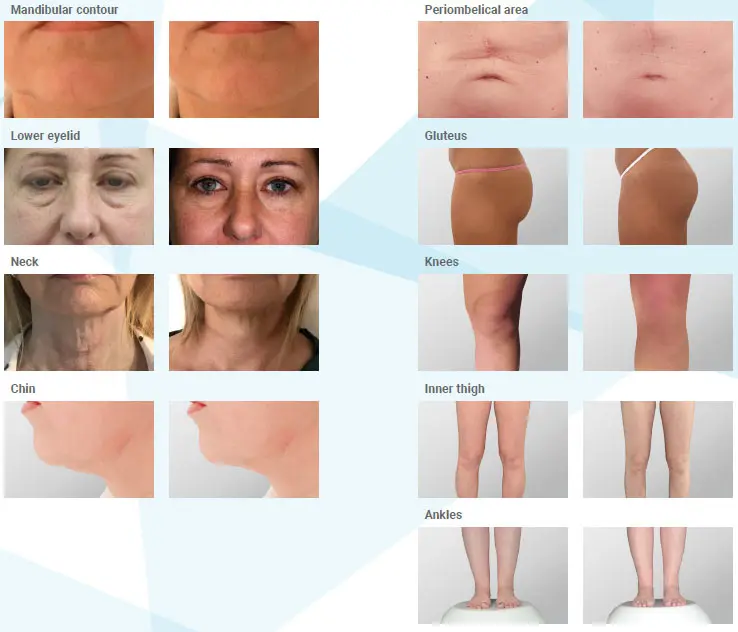 Best Quality Endolaser Diodo 980 Nm 1470 liposuction Diode Laser 980 1470 Nm For lipolysis 1470 Diode Laser fat reduction