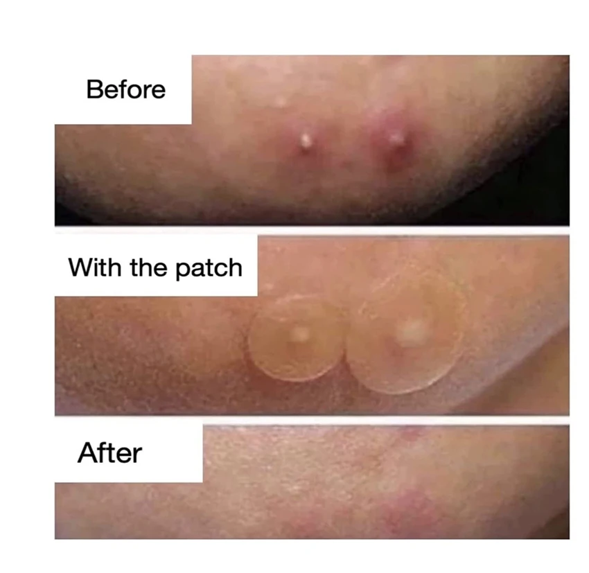BLUENJOY 2023 The Most Popular Hydrocolloid Pimple Patch Acne Sticker For Acne Removal