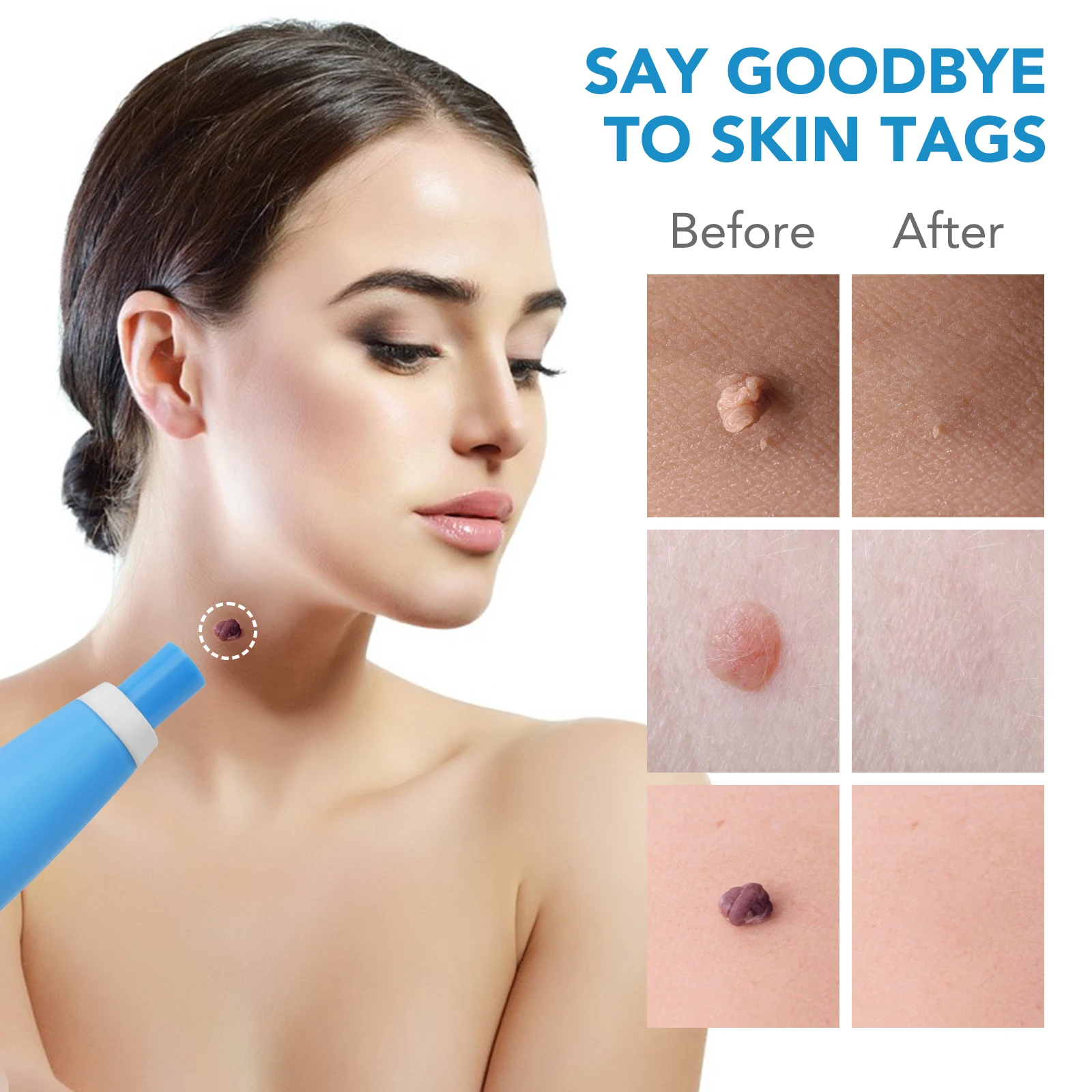 SUFUDUN Factory Skin Wart Tag Remove Kit With Cleansing Swabs for Face Mole Skin Tag and Mole Remover Pen
