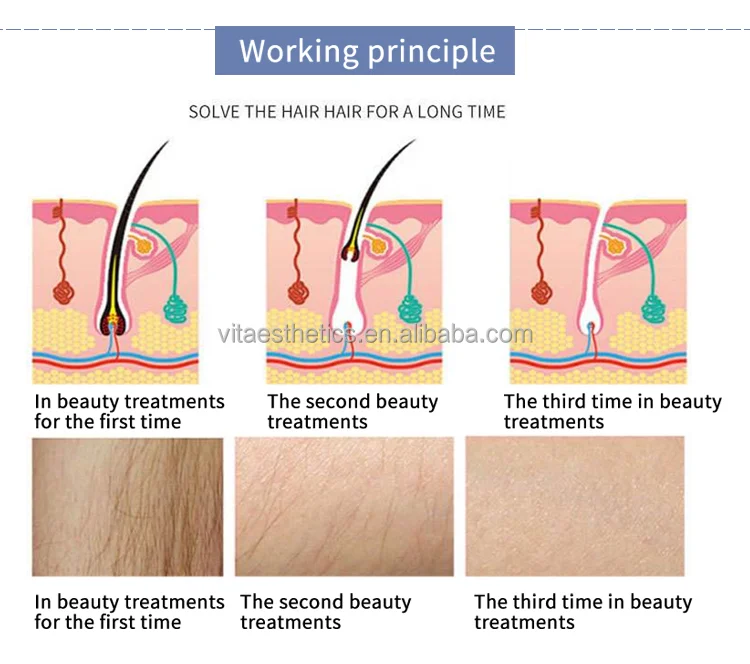 ipl hair removal5.png