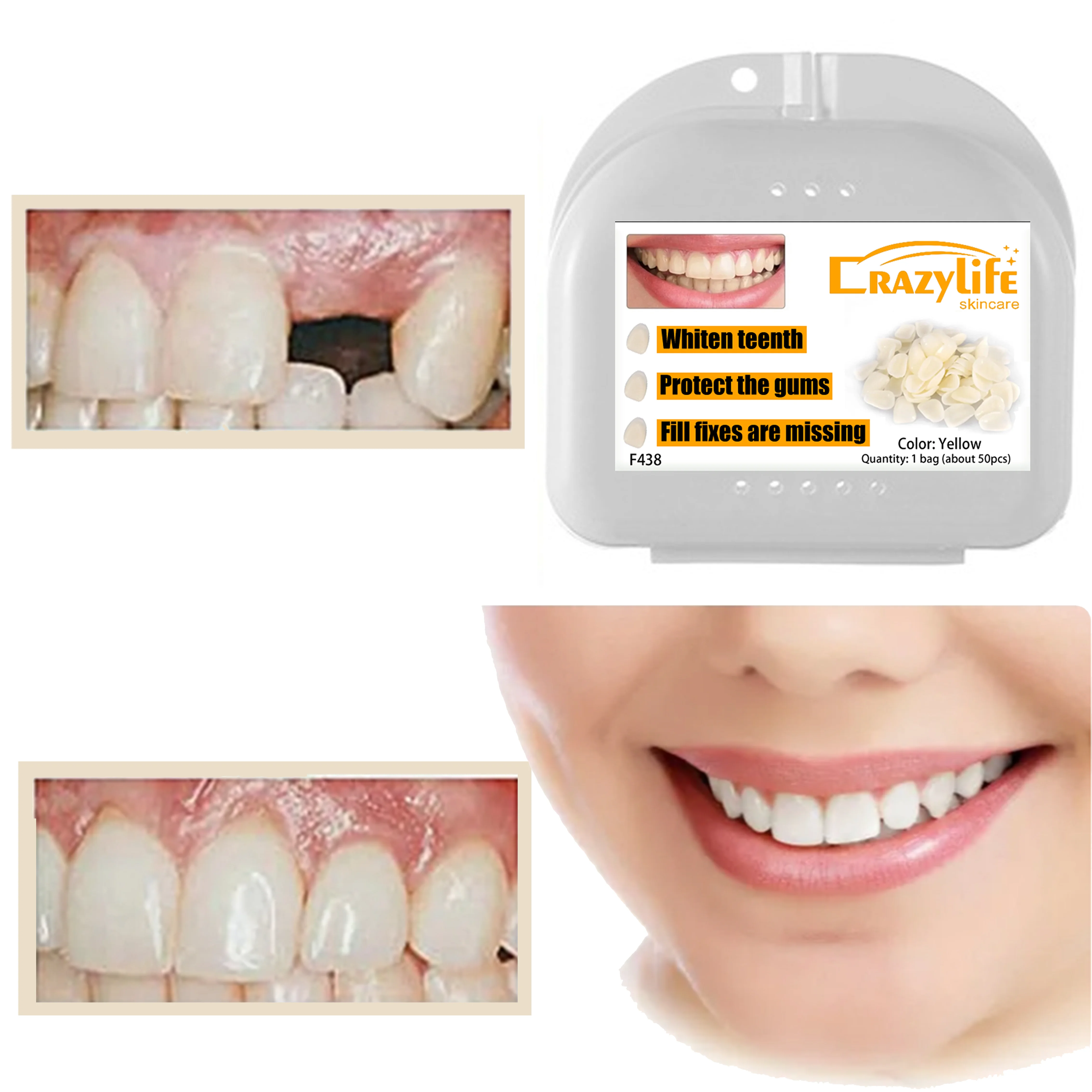 50PCS/Bag Teeth Veneers Anterior Upper Temporary Crown For Dental Oral Care Dentist FalseTeeth Tooth Whitening Repair Sets