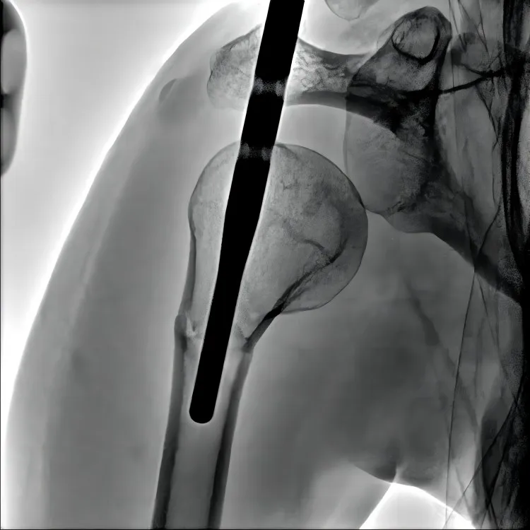 Oncology interventional treatment medical x ray c arm system