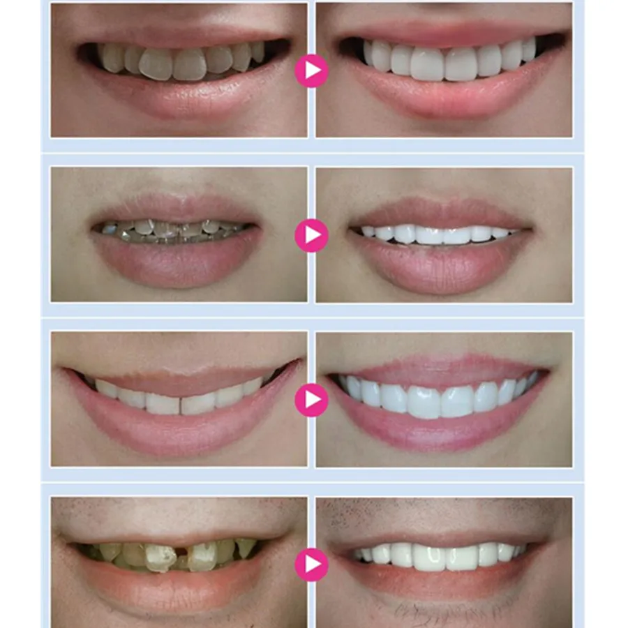 Sowsmile 5D Dental Dentist Oral Care Hygiene Bleach Teeth Whitening Strips Wipe White Kit  Eraser Tools Materiais Instrument