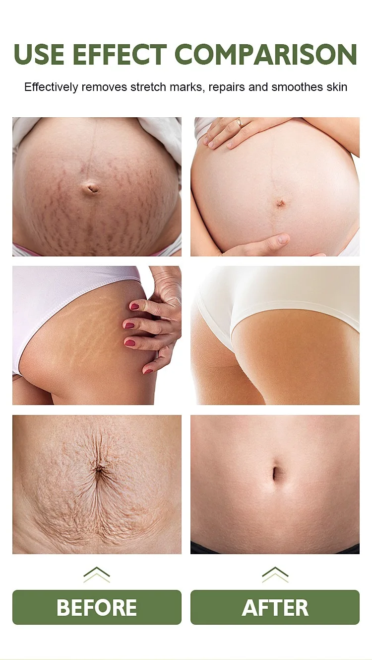 Wholesale Color Removal Tightening Skin Repairing Skin Care Stretch Marks Removal Cream For Body