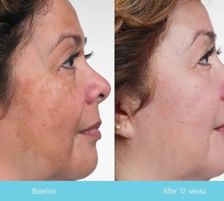 New Arrival Hot Selling  Modified Jessner Peel for Acne Hyperpigmentation Chemical Peel Solution for Skin Whitening