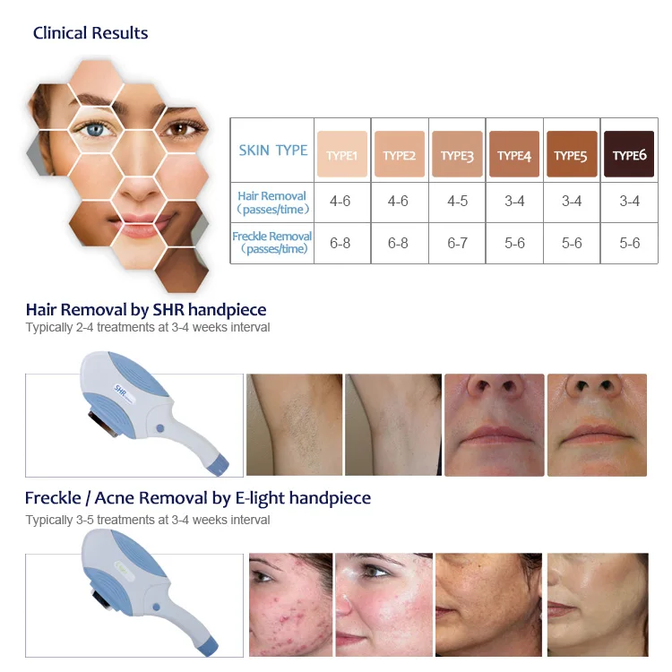 
KES Professional good quality luminic portable shr ipl hair removal machine 