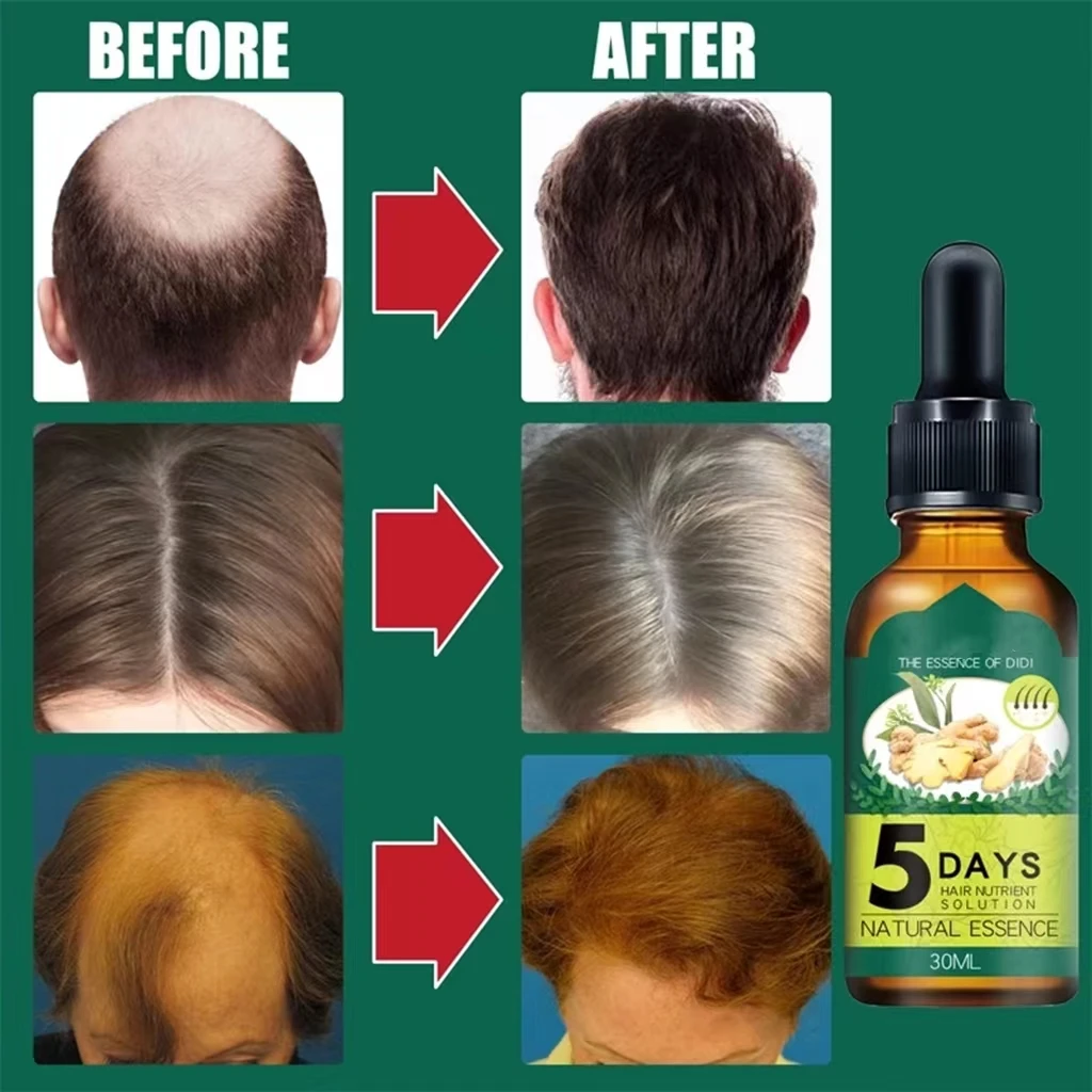 5 Days Ginger Hair Growth Products Natural Anti Hair Loss Prevent Baldness Treatment Fast Growing Nourish Dry Damaged Hair Care
