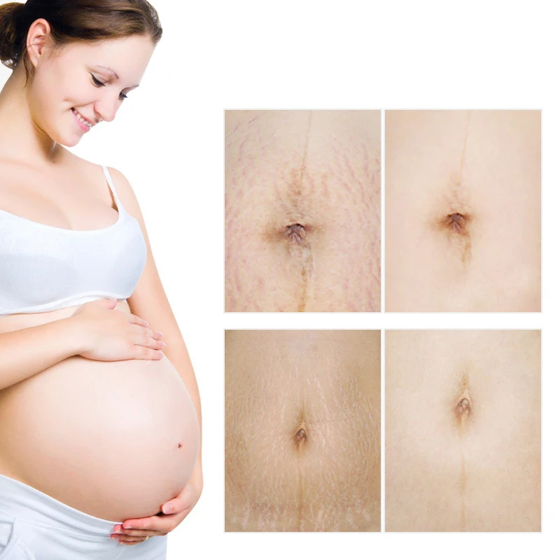 Оптовая продажа Косметический Крем Aichun для ухода за кожей против растяжек Натуральный Для Удаления с быстрой