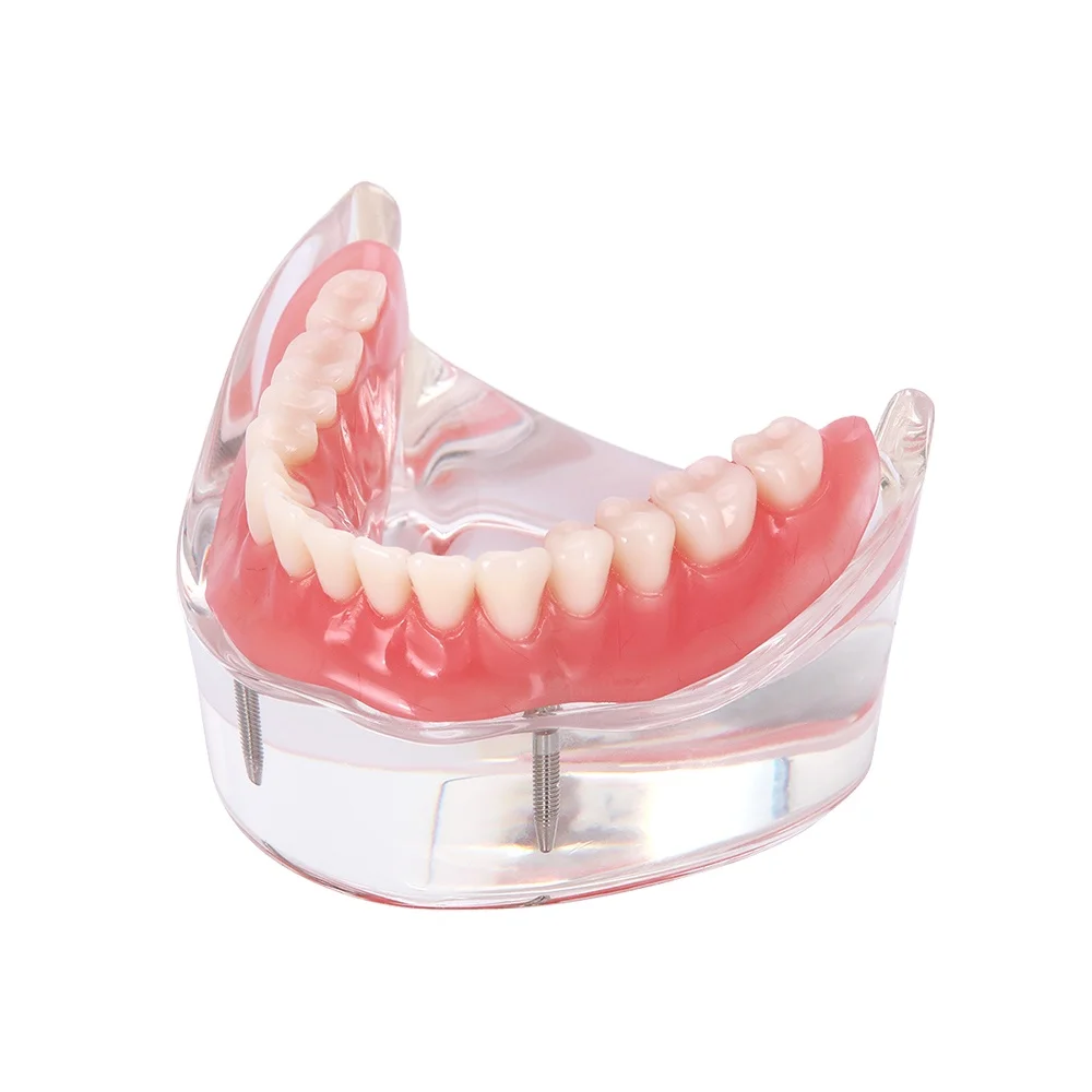 Высококачественная модель зубного импланта для восстановления зубных протезов/модель зубных протезов