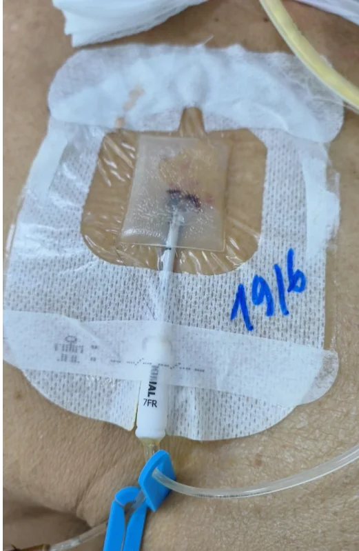 Disposable Sterile Waterproof CHG Chlorhexidine Gluconate I.V. Securement Dressing