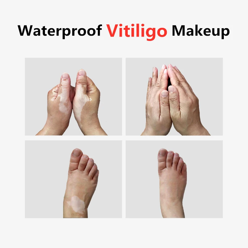 Women Men Face Discolored Skin Vitiligo Patches Makeup Vitiligo Leukoderma Covering  Waterproof Concealer Cream