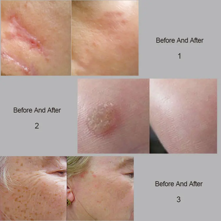 
KES Himalaya Factory co2 fractional laser for sale 