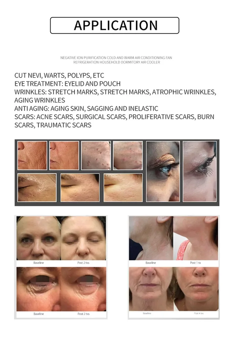 Beauty products cold plasma personal beauty device in the world cold plasma machine disinfects the skin