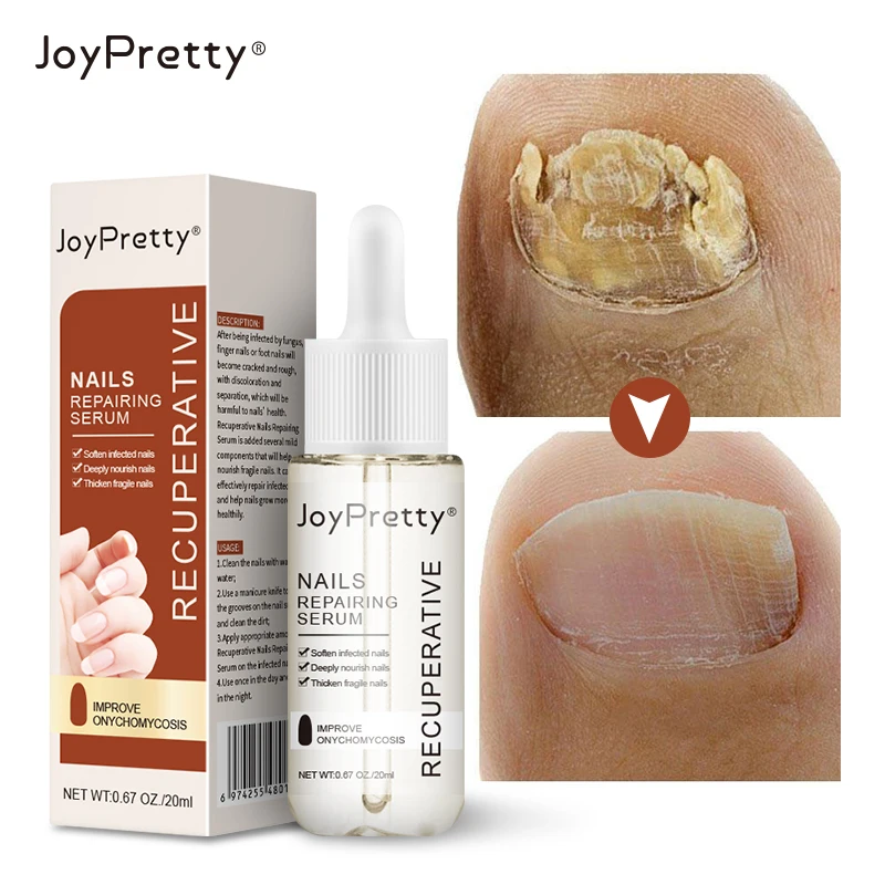Сыворотка для лечения Ногтей от грибков JoyPretty, уход за ногами, отбеливание ногтей на пальцах ногтей, удаление грибка, гель от инфекции 20 мл