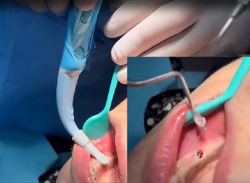 Dental  Implant Detector Precise Implant Locator Rotary 270degree Sensor Head for Minimally Invasive Second Stage Surgery