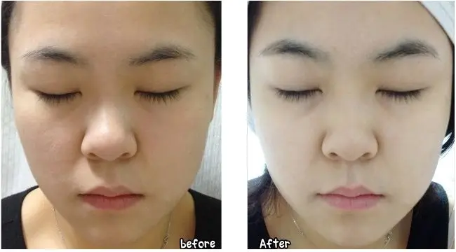 
Treatment of vitiligo Raw material and benoquin cream Pure monobenzone 99%/ Monobenzone Whitening Cream 40%-60% 