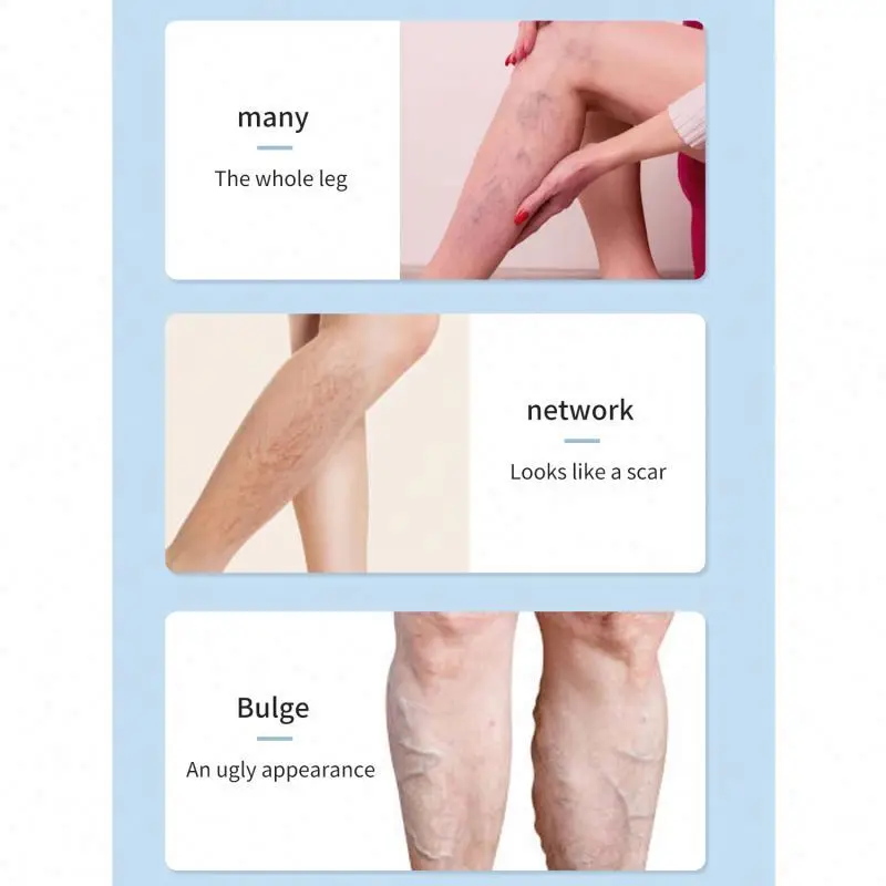 Spray Relief Phlebitis Angiitis Remedy Patch Spider Veins Edema Nerve Pain Earthworm Leg treatment cream Varicose Vein Spray