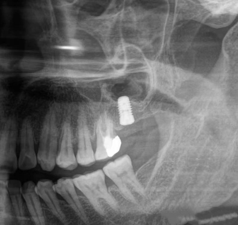 Manufacturer Approved micro-dual tread dental implant tooth Implant with compatible abutment in dental Medical