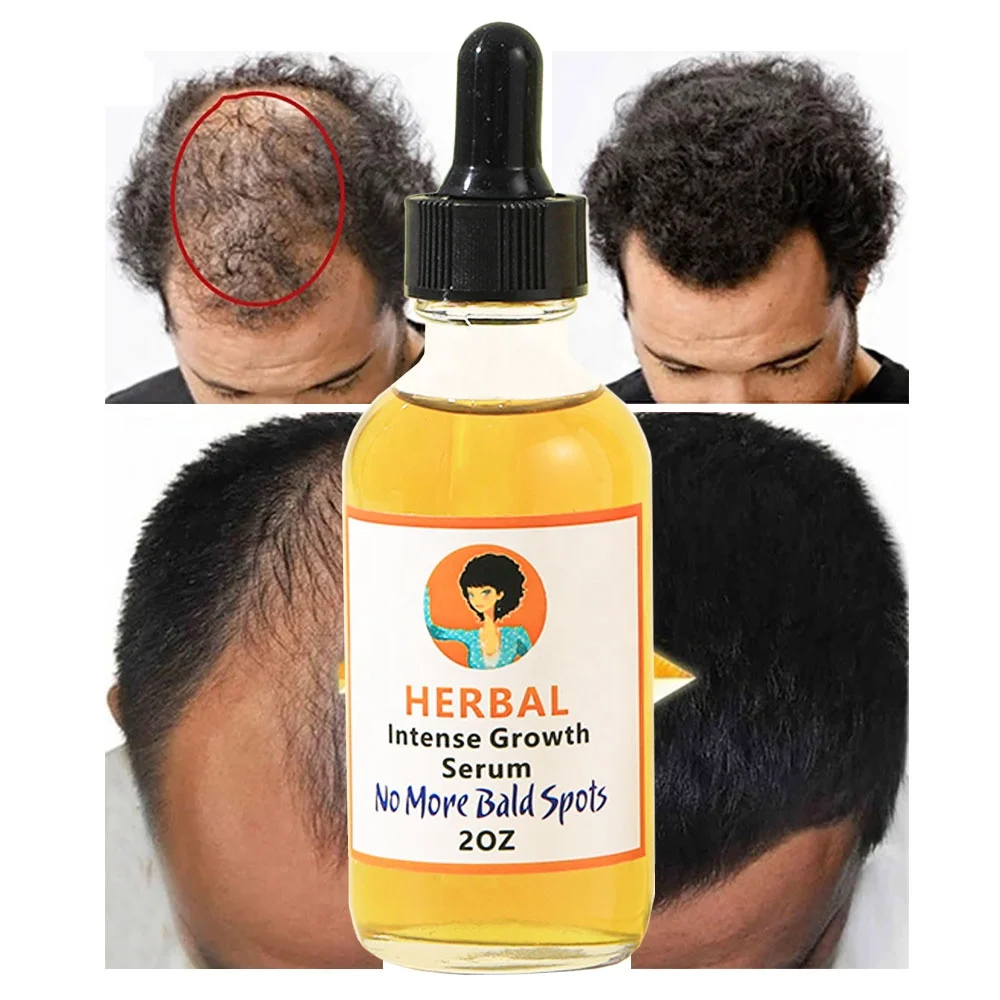 Most Sold Scalp Hair Growth Products Repair Anti Hair Falling Men Organic Hair Growth Oil for Baldness