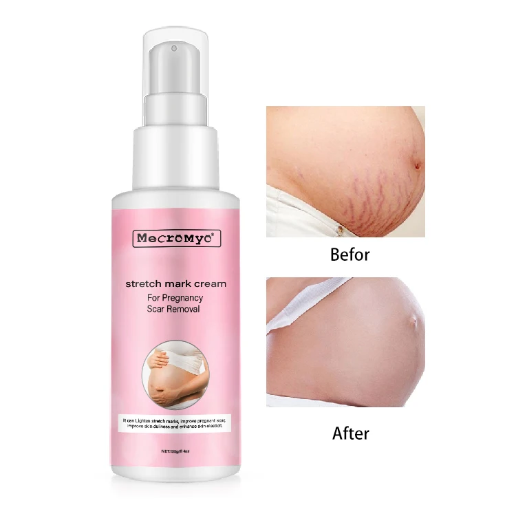OEM /ODM Private Label Body Skin Care Removal Stretch Mark Skin Vegan Anti Scars Wrinkles Pregnancy Scar Cream