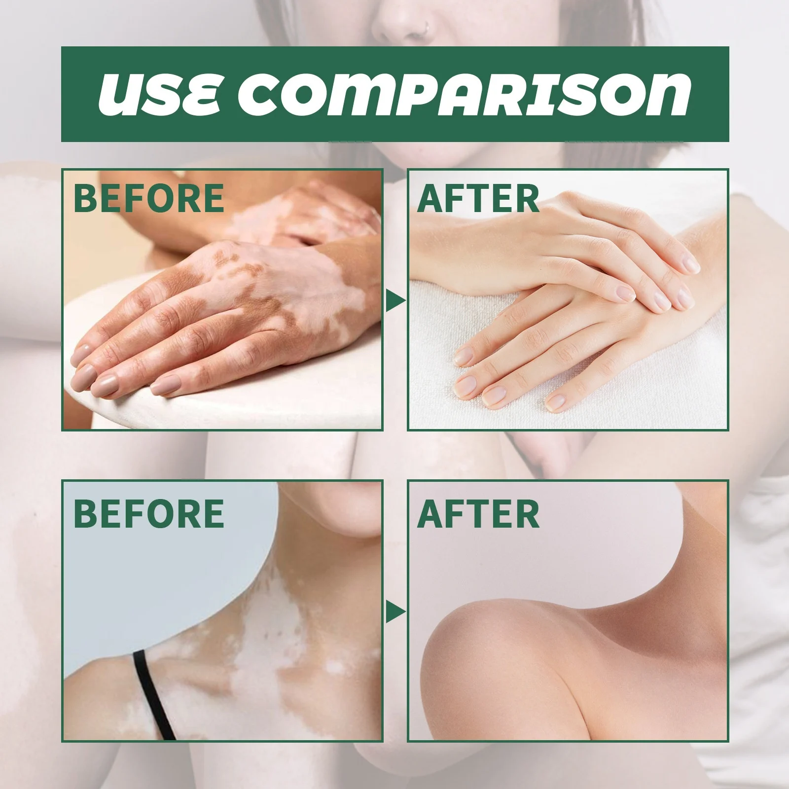hot sale vitiligo cream white spot and vitiligo treatment skin care topical cream