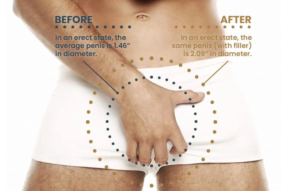 Heremefill Butt Enhancing Injections Buttock Enlarge Hyaluronic Acid Filler Injection 20ml