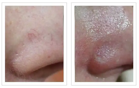 Berylas 1470nm diode laser for spider vein removal/vascular surgery EVLT device