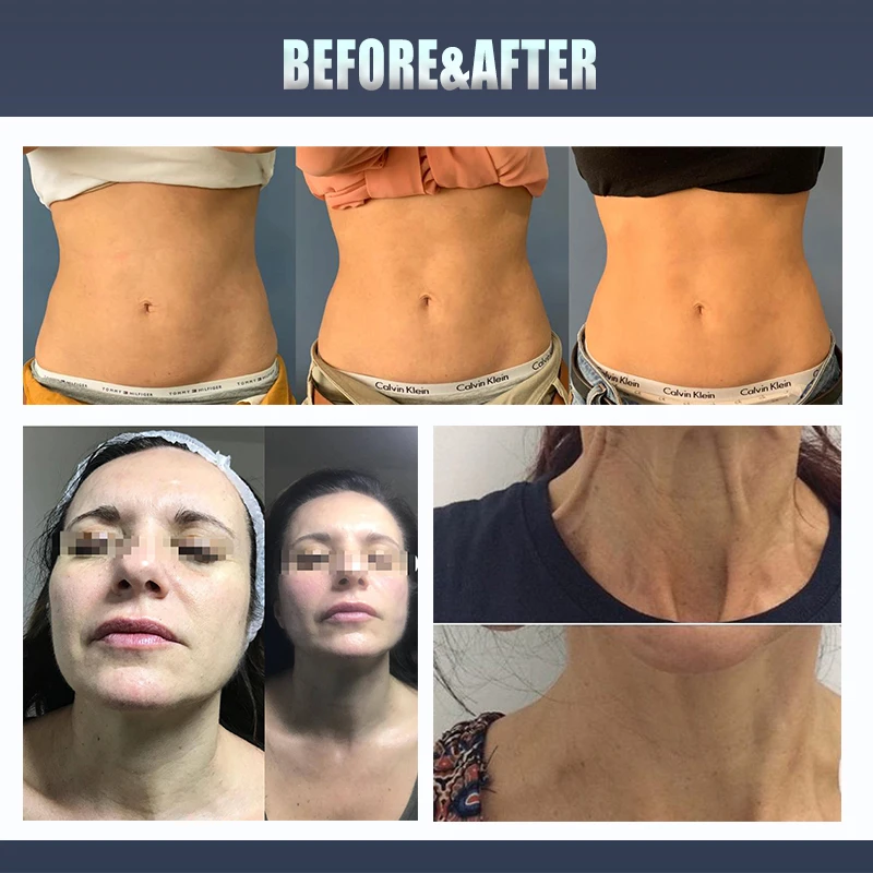 3D 4D Hifu Machine For Salon Clinic 11 Lines V-Max Hifu Eye Facial Skin Tighten And Lift 3 In 1 5D Hifu Medical CE